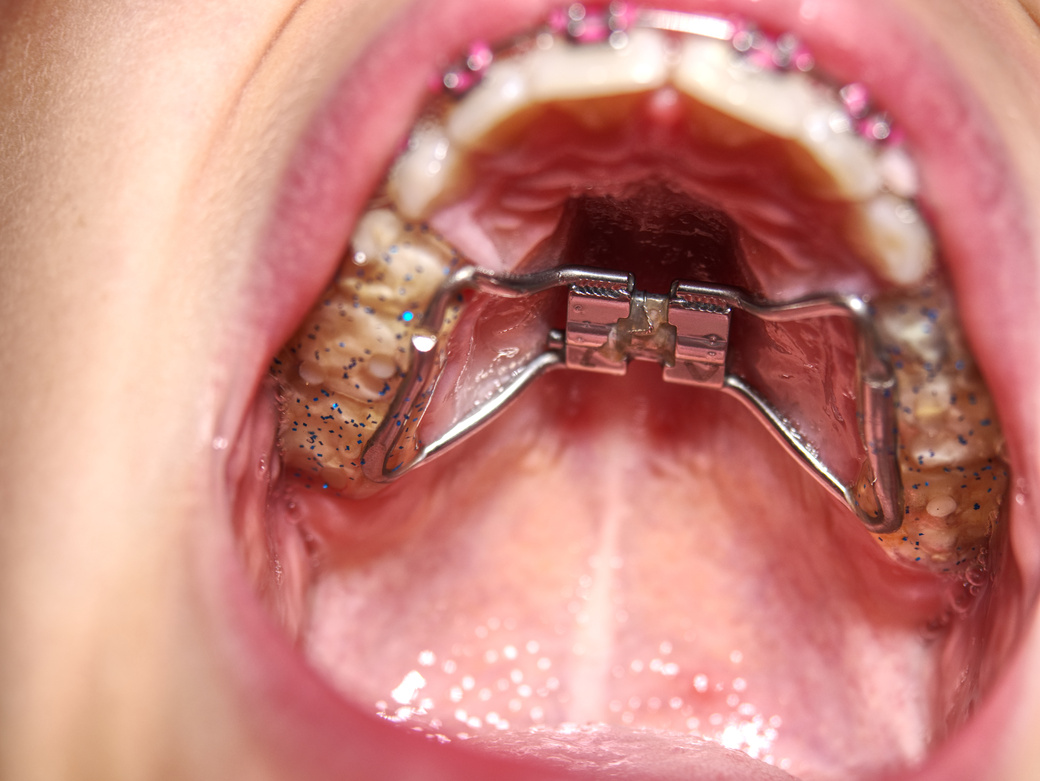 Kid Wearing Orthodontic Palatal Expanding Trainer