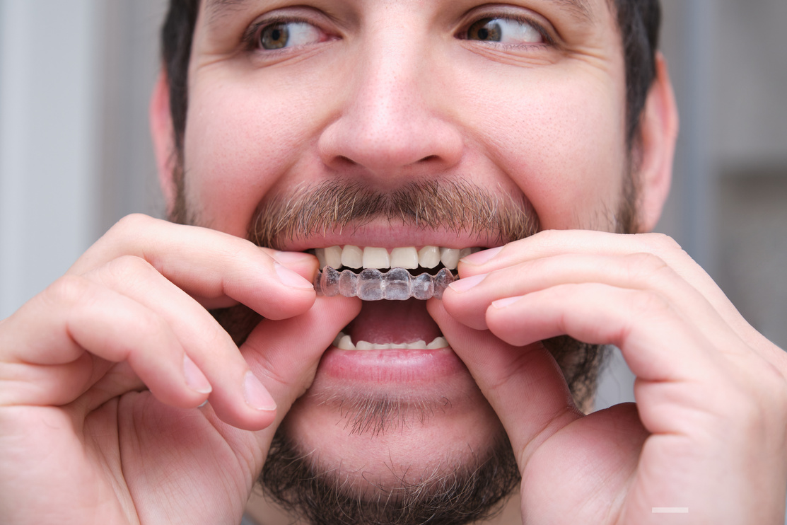 Close up of young latin man putting orthodontic silicone trainer or invisible braces aligner. Mobile orthodontic appliance for dental correction.