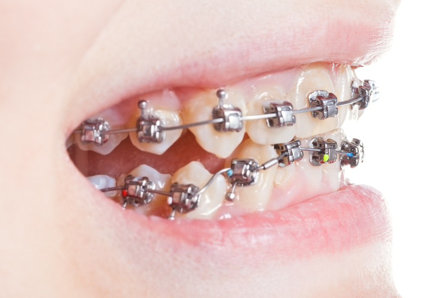 Side View of Dental Brackets on Teeth Close up
